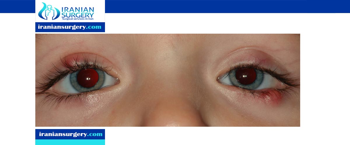 Chalazion surgery recovery time Iranian Surgery