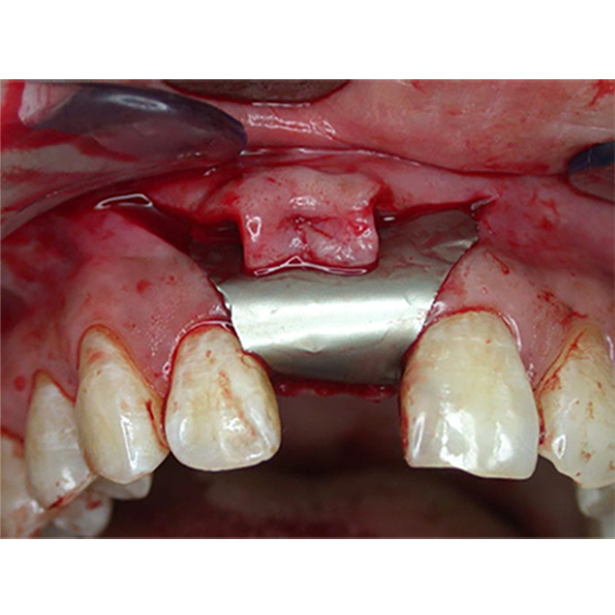 Membranes Implant Resources Centre (Far East) Limited