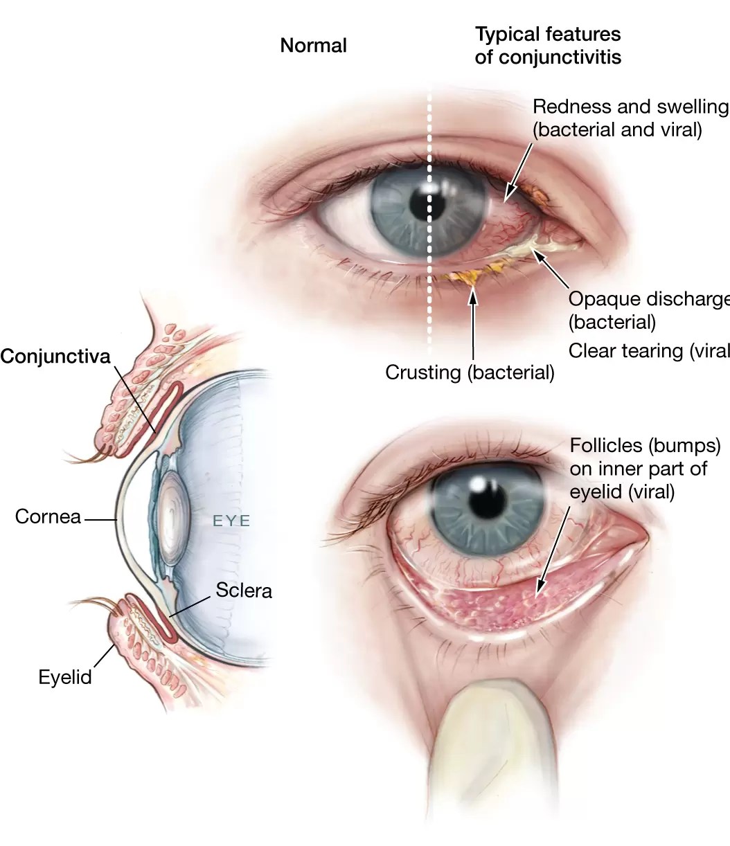 Pain In Corner Of The Eye Can Be A Symptom Of Dangerous Diseases | Iristech