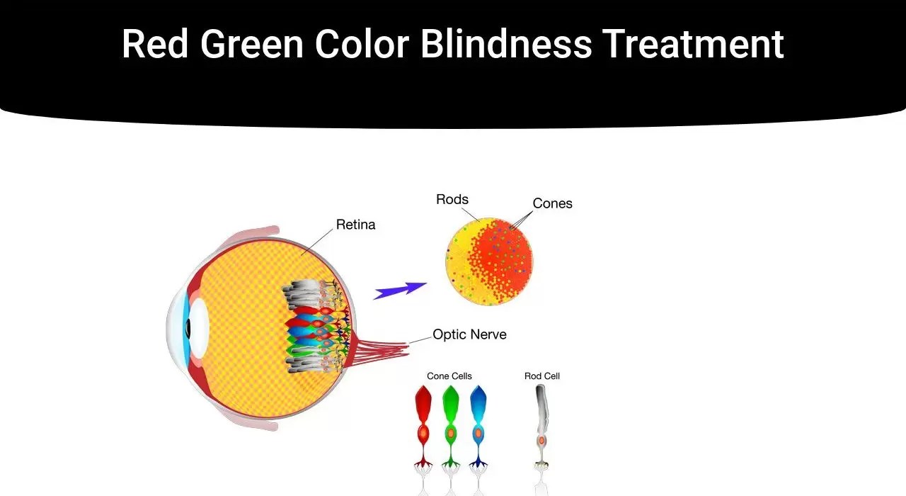 Red Green Color Blindness Treatment IrisTech
