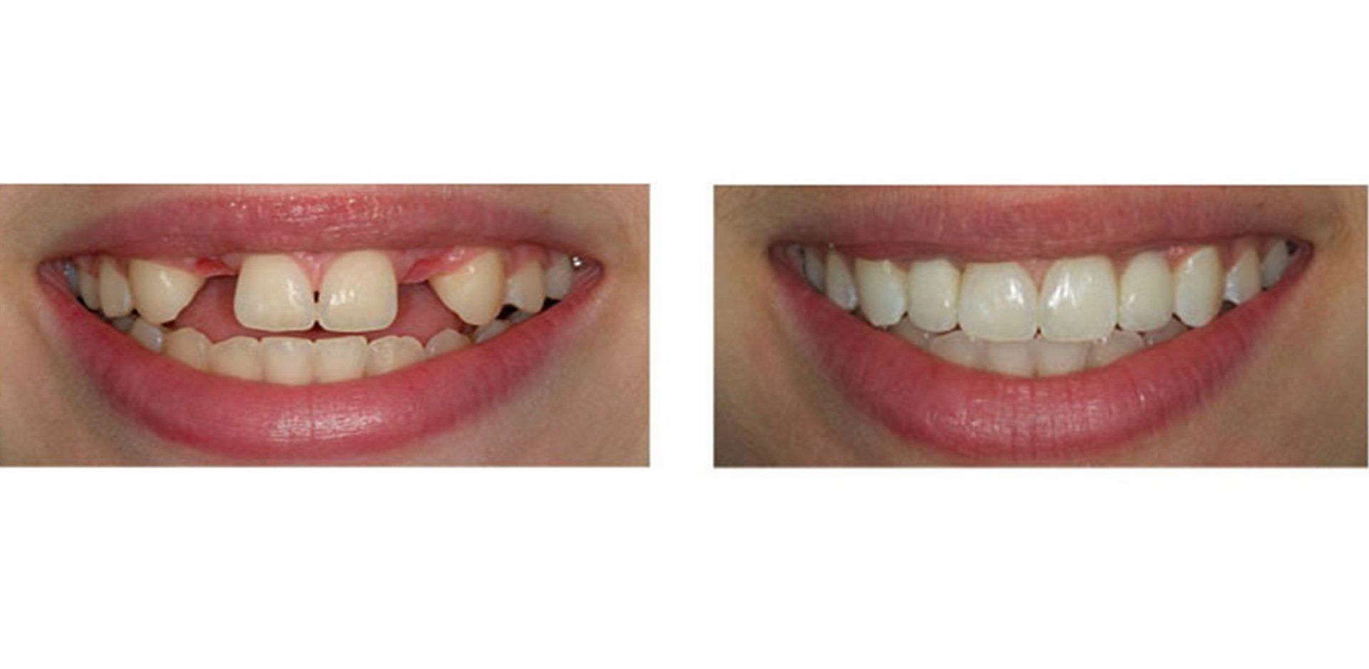 Dental Implants the Ultimate Tooth Replacement!