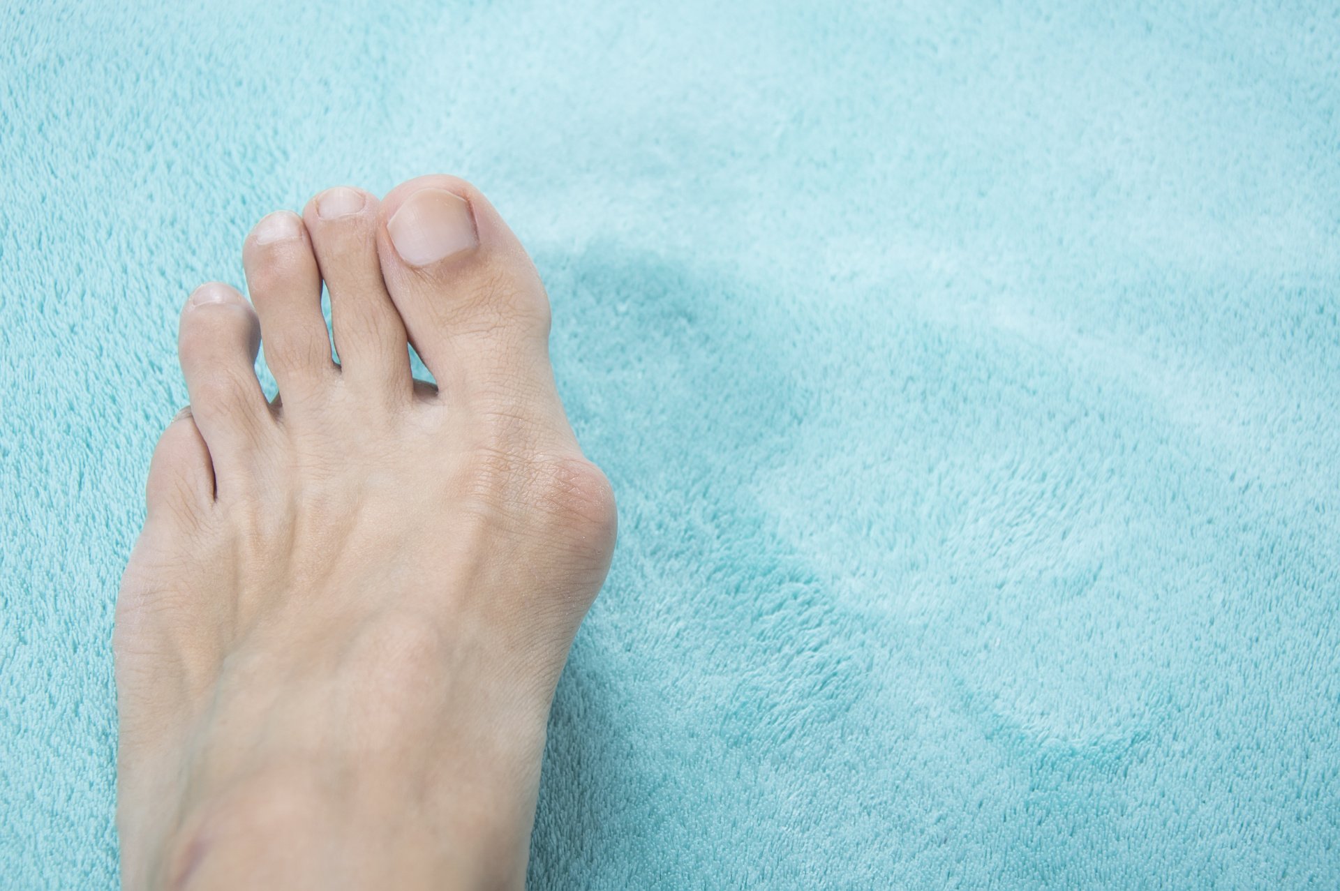 Nonsurgical Bunion Treatment