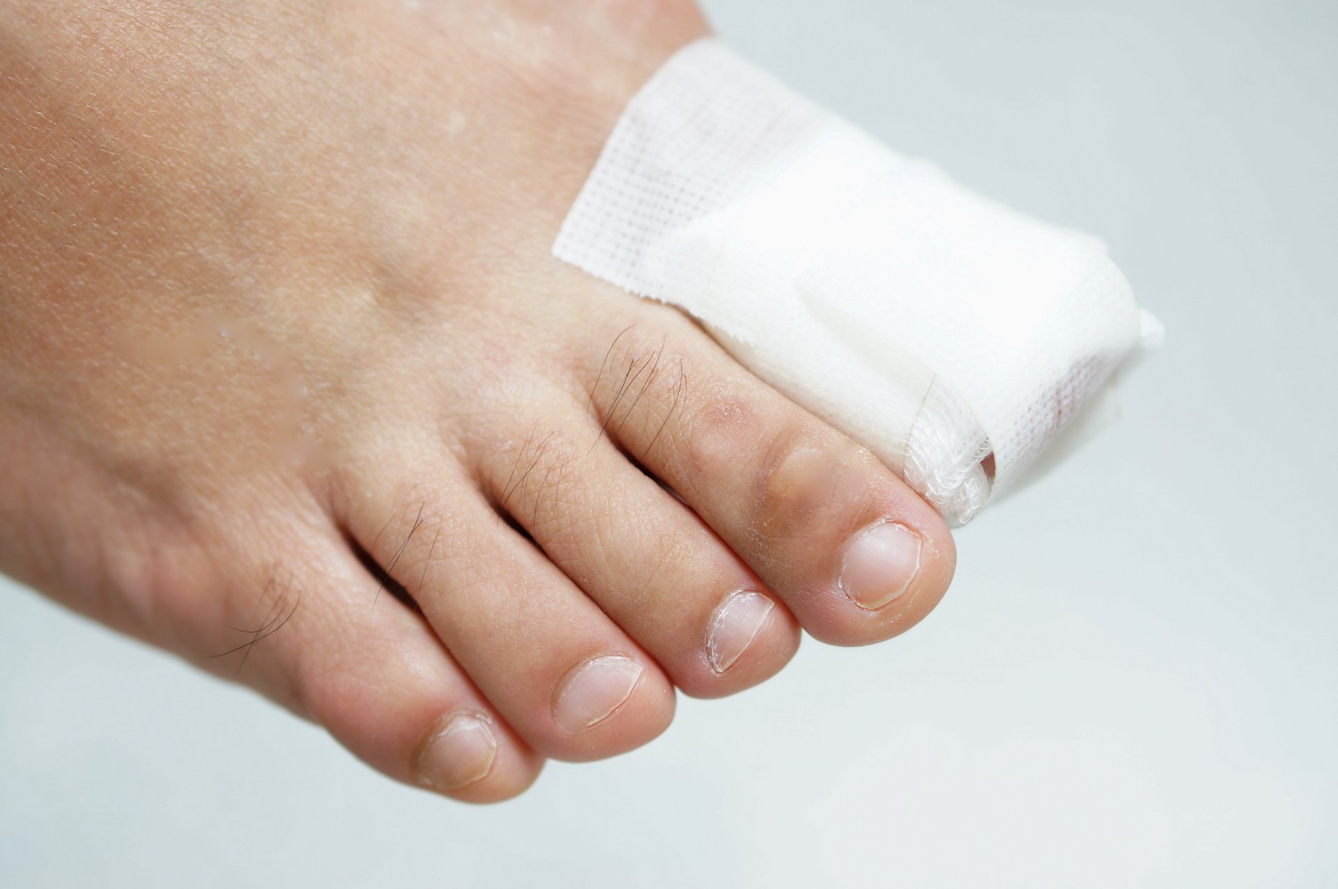 Ingrown Toenails Everything Baton Rouge Patients Should Know