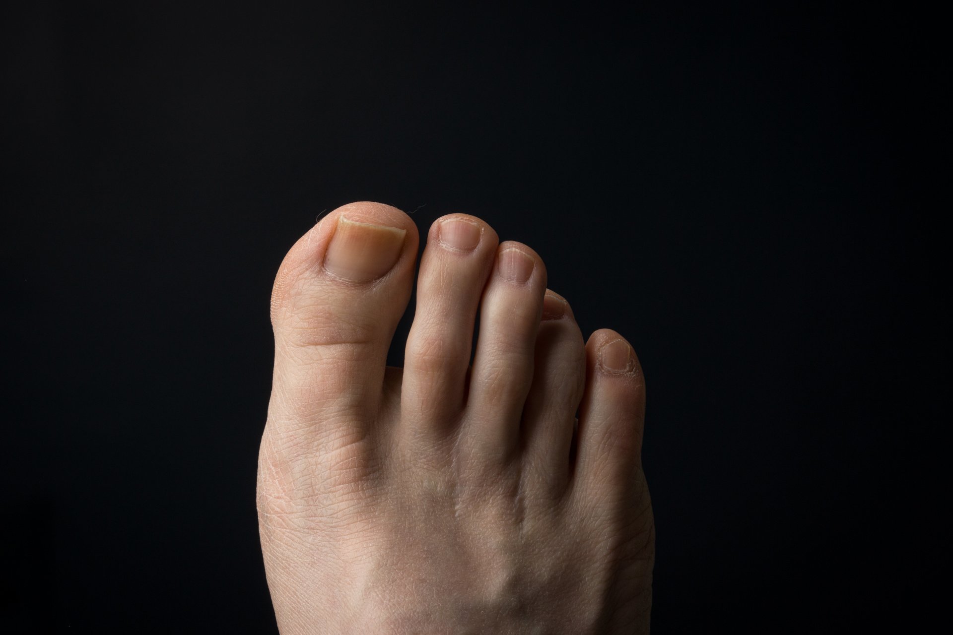 Why Does the Ball of My Foot Hurt?