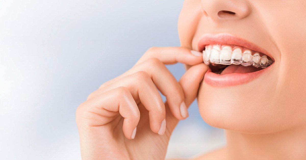 How Long Does It Take to Straighten Teeth with Invisalign?
