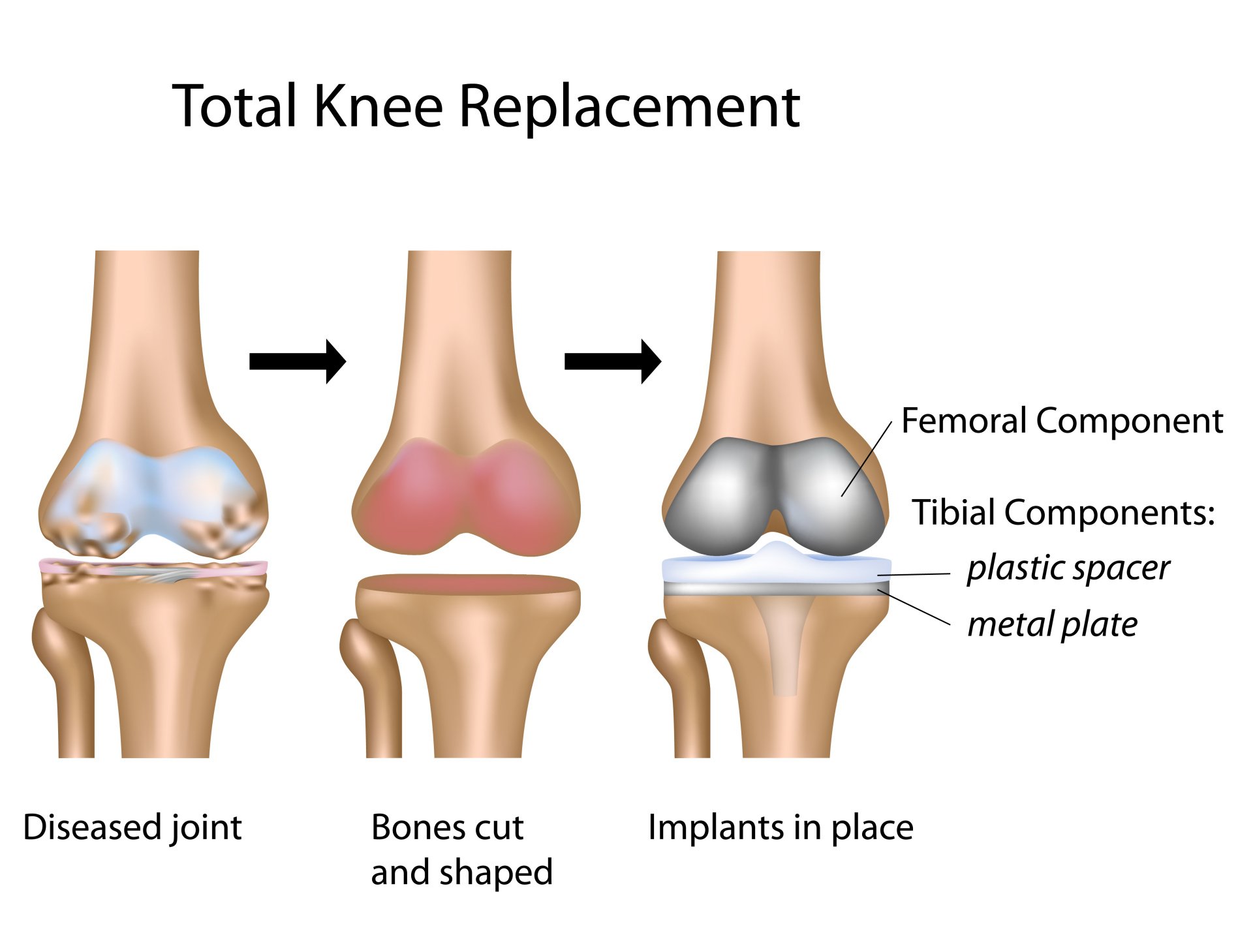 Total Knee Replacement (TKR) Dr A. Theodorides Knee Surgeon Specialist