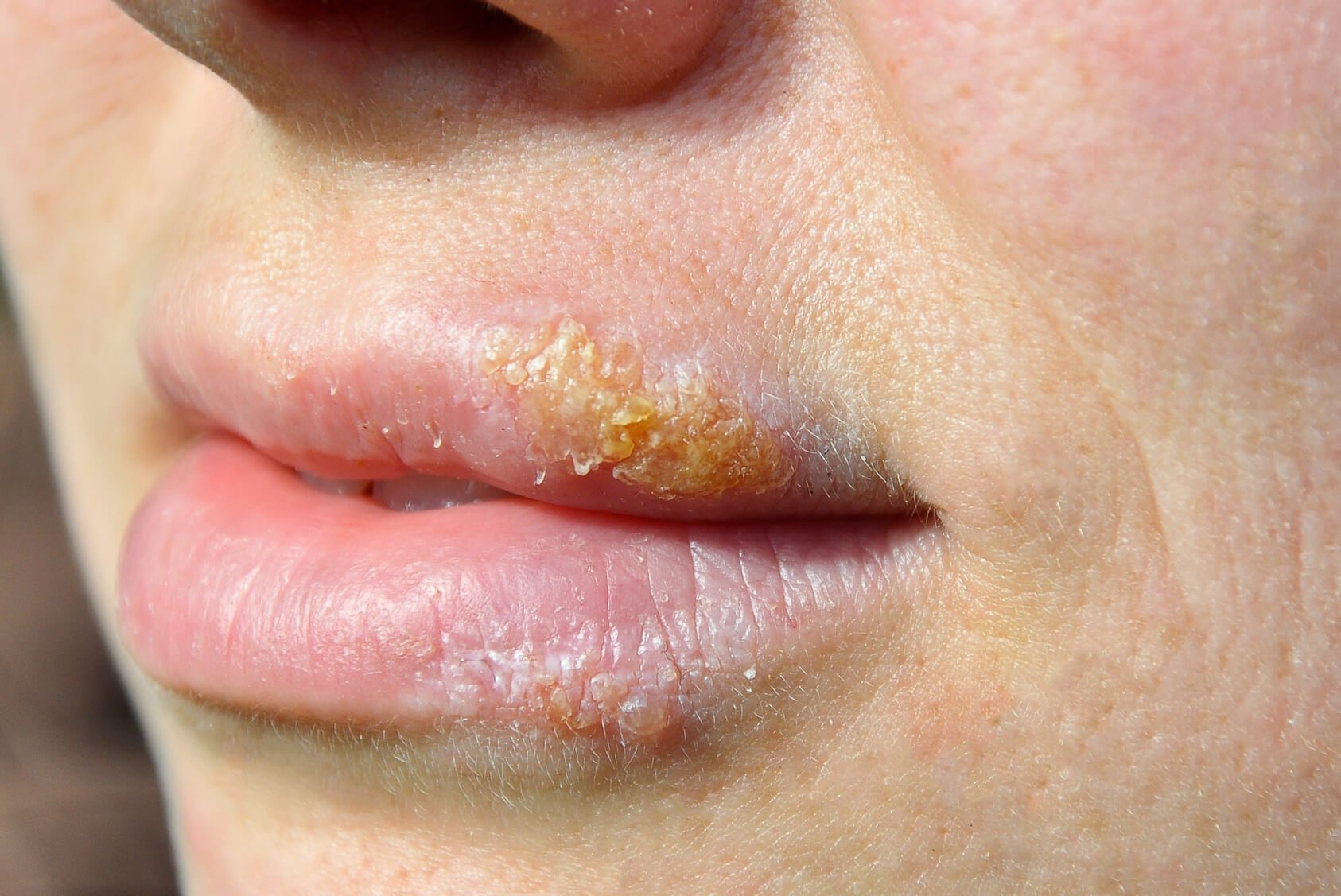 Cold Sore Treatment Orchard Park, NY James M. Blake D.D.S., PC