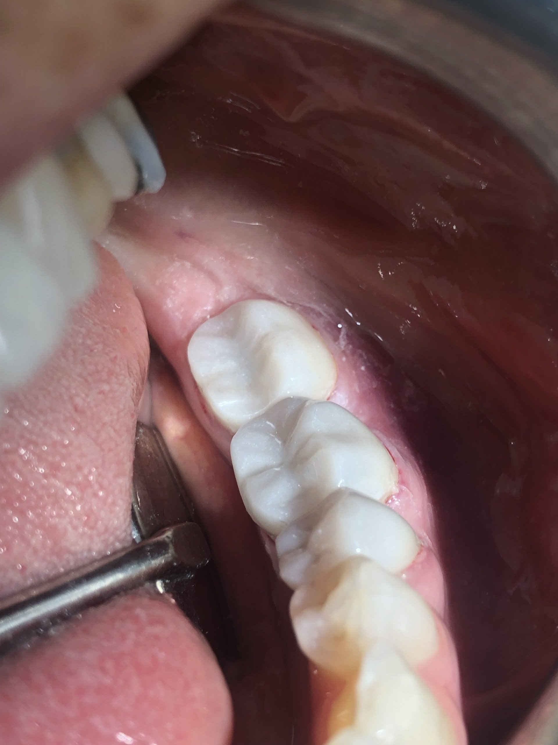 Composite Dental Filling Near Me In Bay Harbor Islands FL 33154