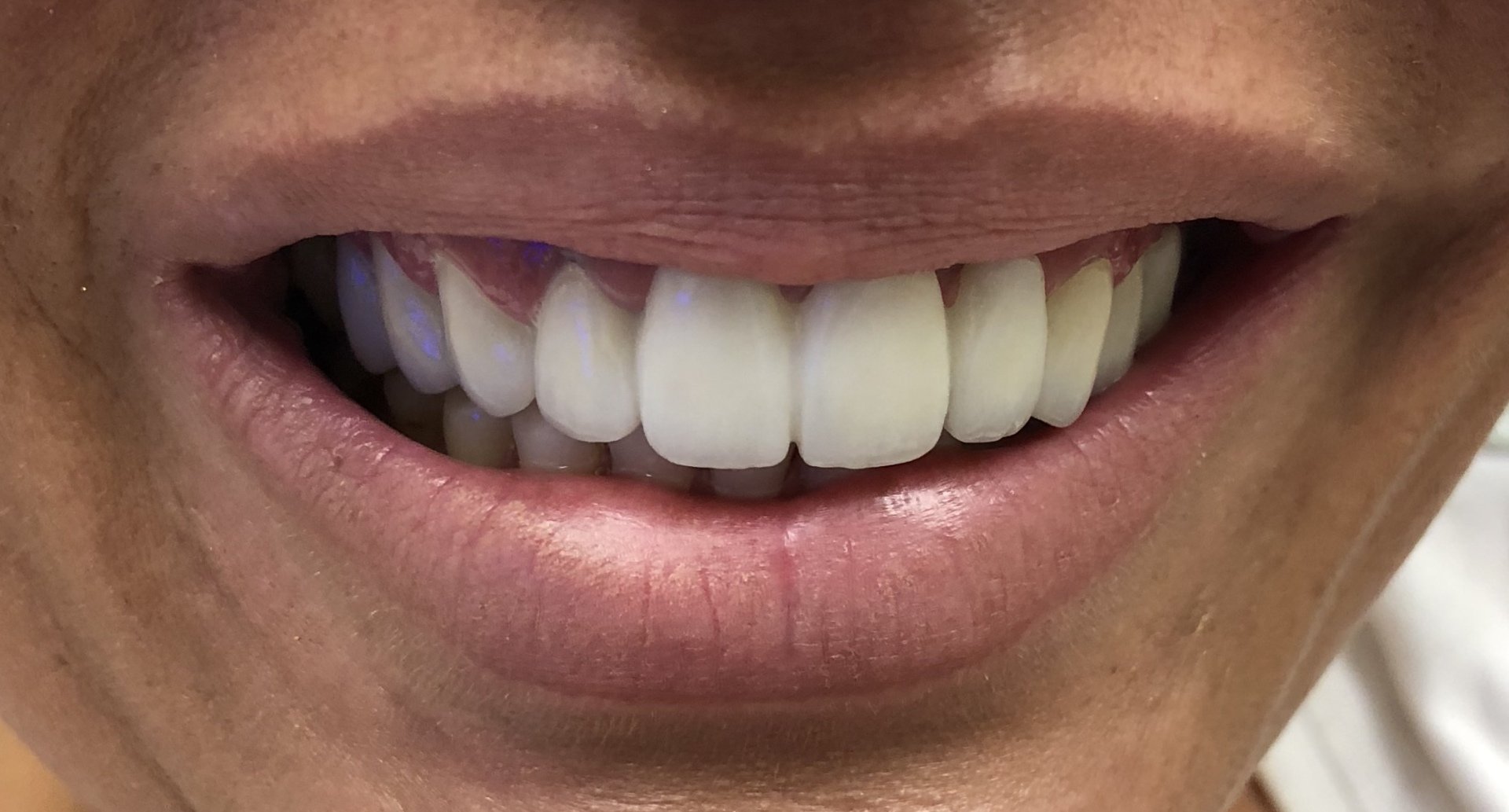 Affordable Dental Implants North Miami Beach FL And Bay Harbor Islands