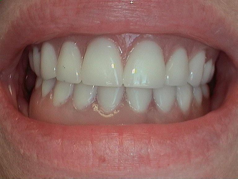 Dental Implants in Louisville, KY Advanced Dental Care