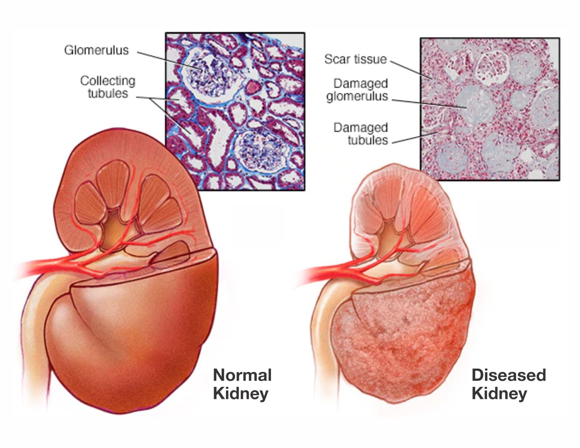 (Diabetic Nephropathy) or Diabetic Kidney Disease