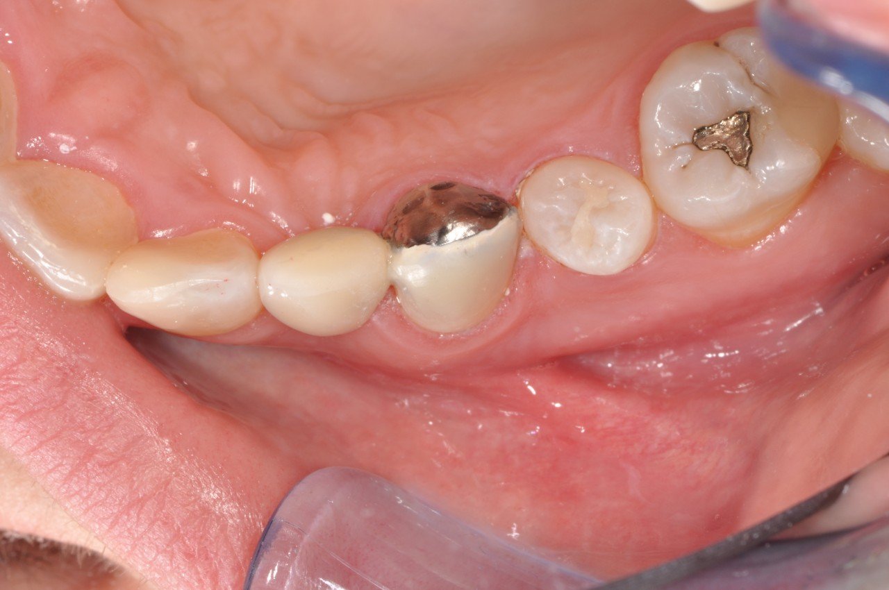 Resin Bonded Bridges Greenwood Grincare Wellington Dentists