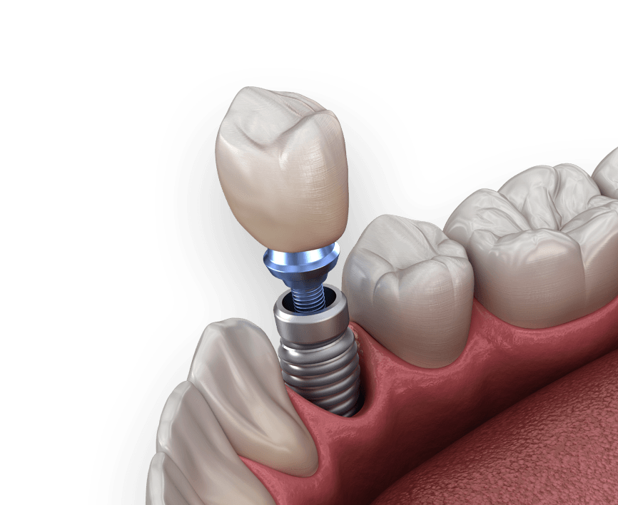 Why Are Dental Implants So Expensive?