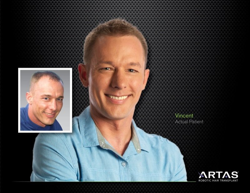 Chicago, IL ARTAS Hair Transplantation Doctor Dr. Yates