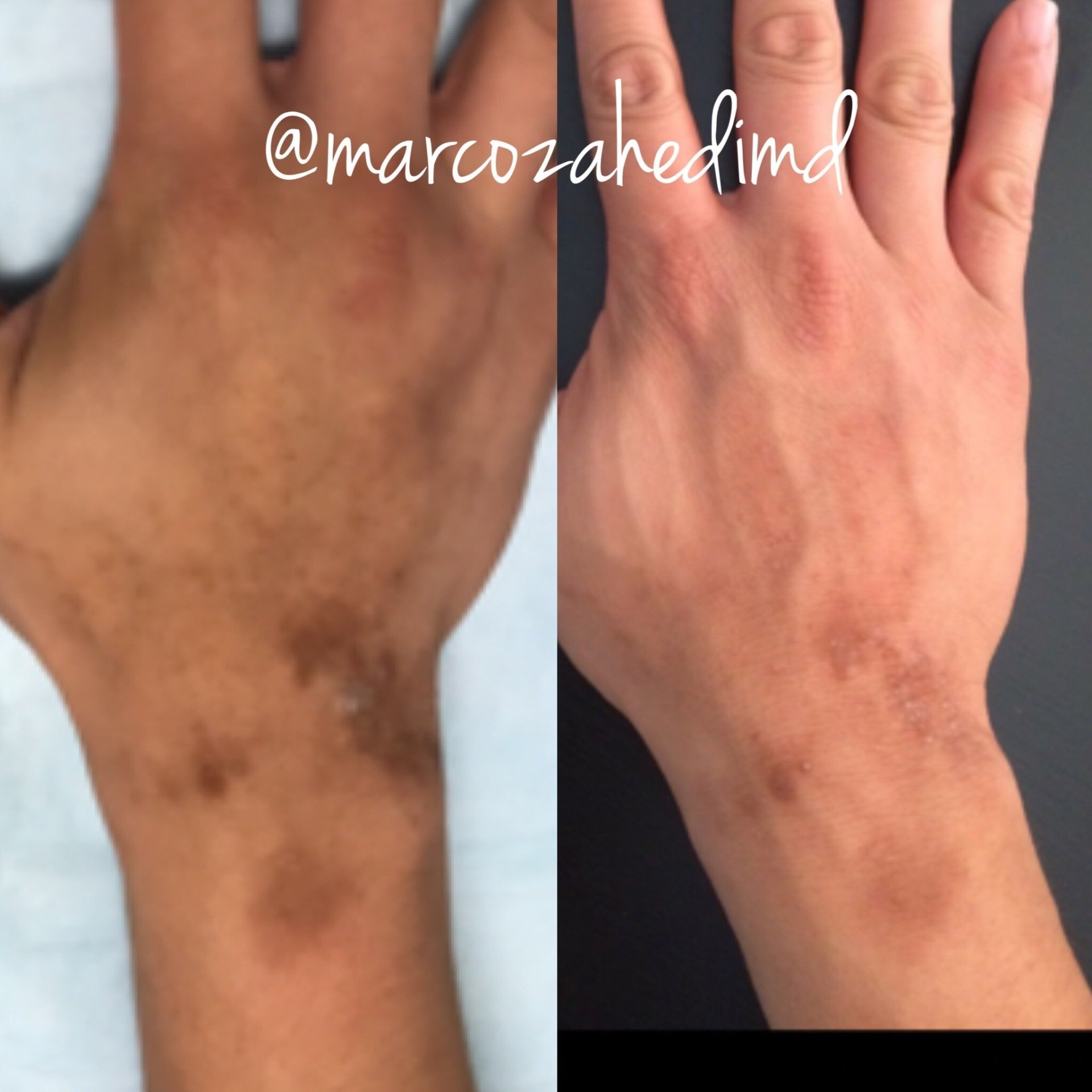 The Best Chicago Laser Skin Rejuvenation Ideas