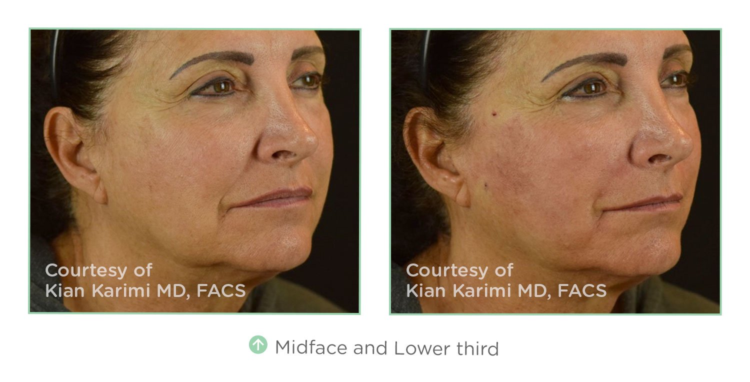 Chicago, IL NovaThreads Procedure Dr. Yates Lifestyle Med