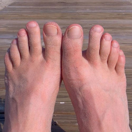 Treatments for ingrown toenails in Kettering