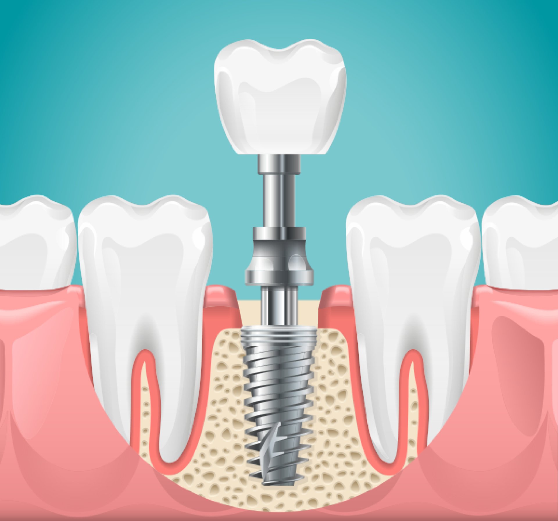 The Advantages and Disadvantages of Zirconia Dental Implants