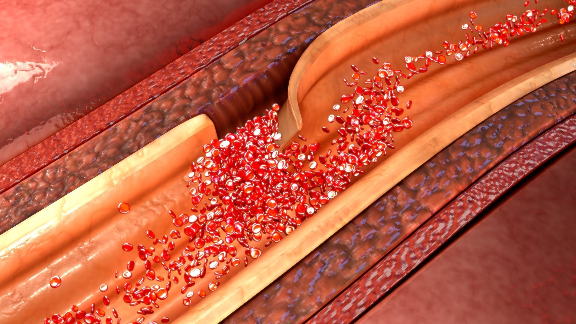 Cervical Artery Dissection
