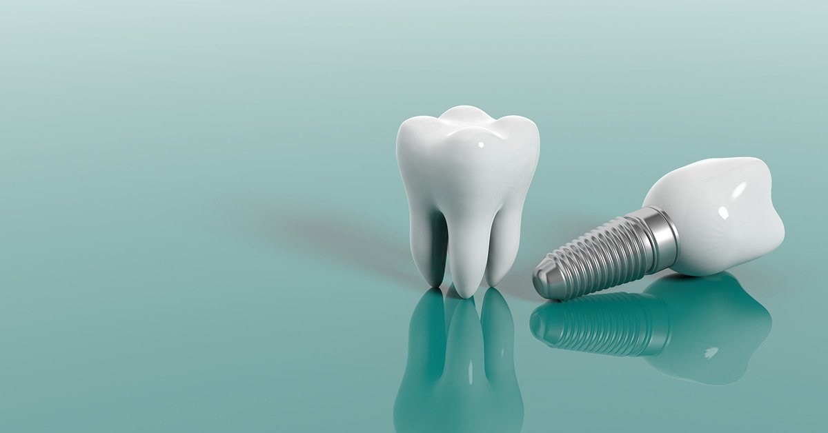 How Long Do Dental Implants Last?
