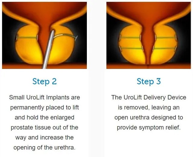 San Antonio Urolift Treatment NonSurgical Procedure for BPH