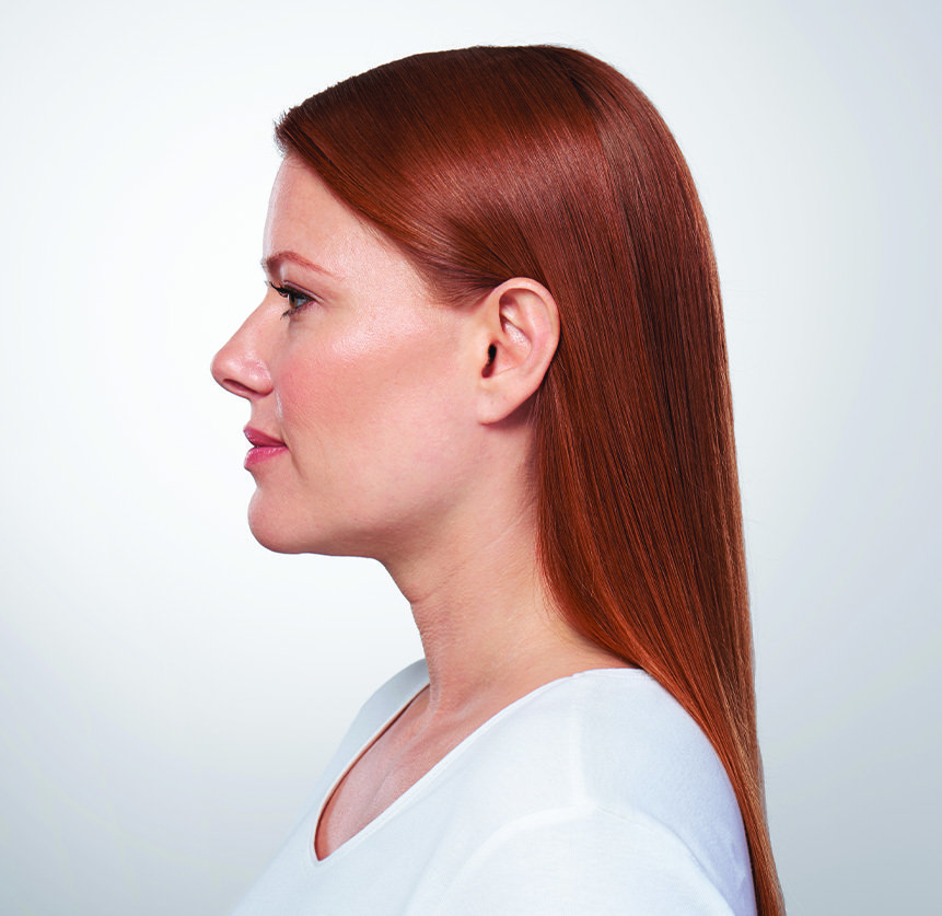 KYBELLA