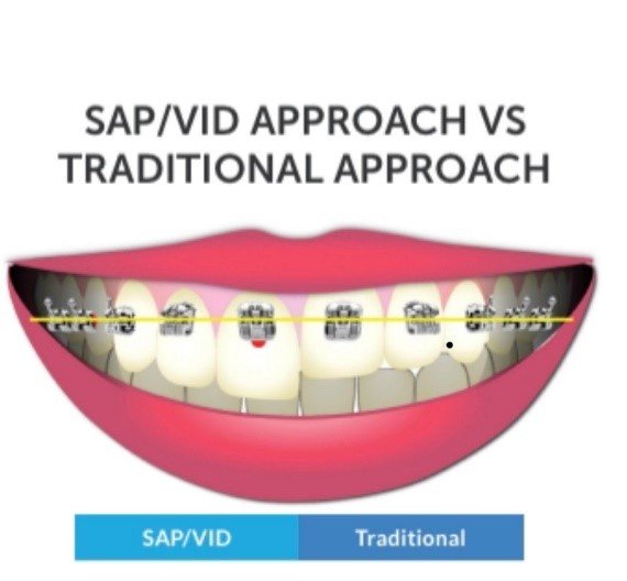 Smile Arc Protection vs. Traditional Brackets