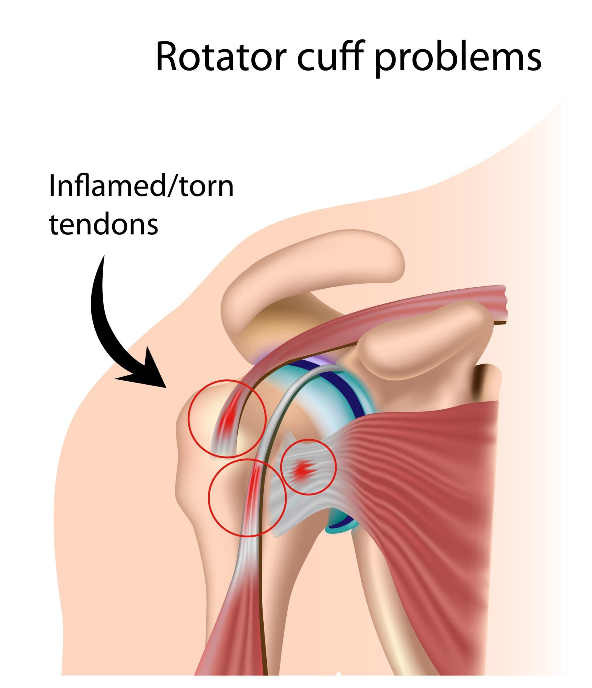 Rotator Cuff Massage Therapy Nassau Eugene Wood LMT