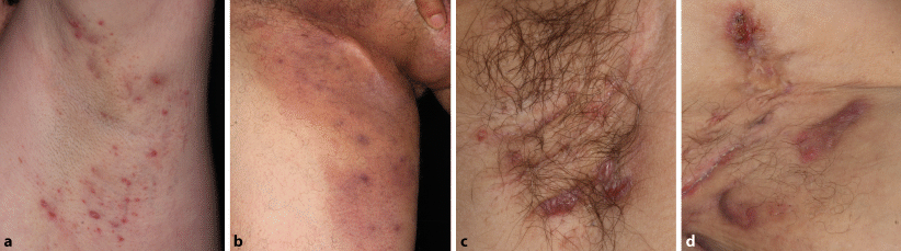 Acne Inversa (Hidradenitis Suppurativa) Treatment at Pine Belt Dermatology
