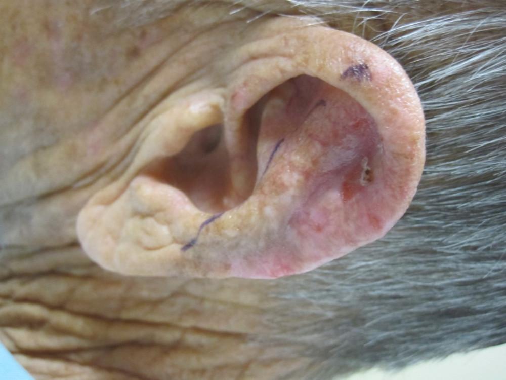 Mohs Case Before & After Infiltrative Basal Cell Carcinoma