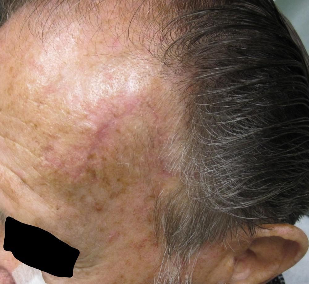 Mohs Micrographic Surgery Basal Cell Carcinoma On The Temple