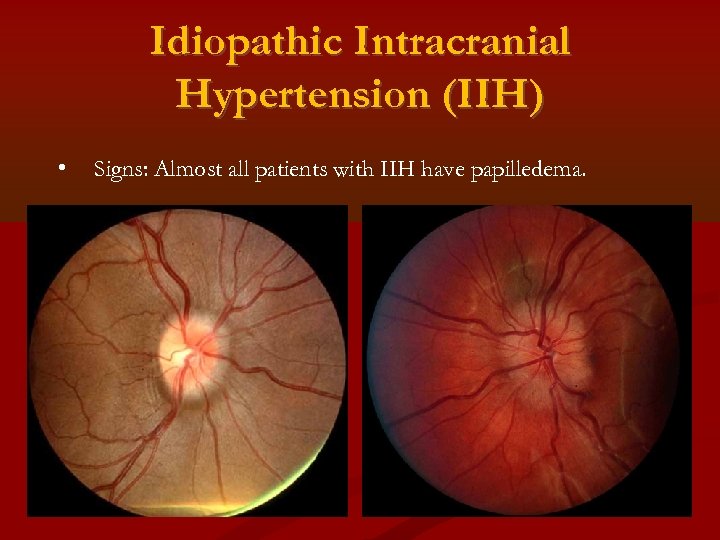 Idiopathic Intracranial Hypertension