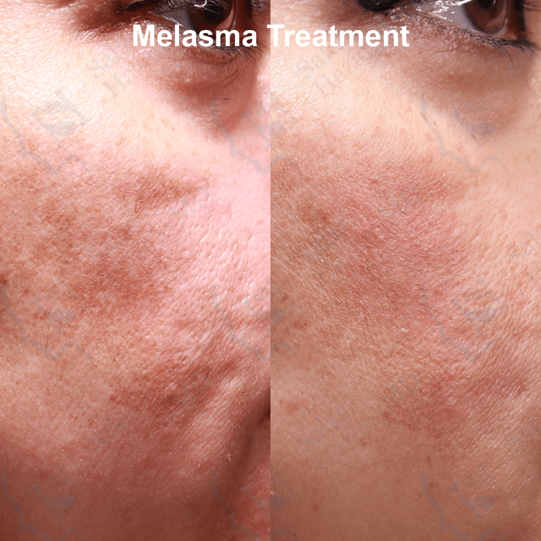 Melasma Treatment + Removal Los Angeles Hazany MD