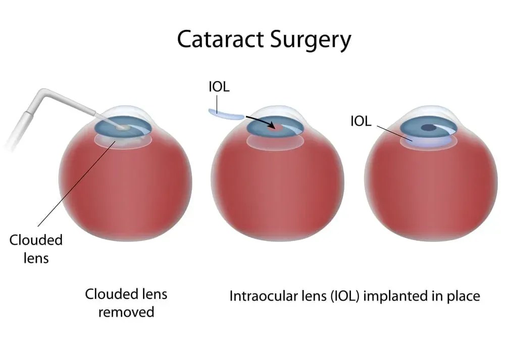 Femto Laser Cataract Surgery South Shore Eye Care, LLP