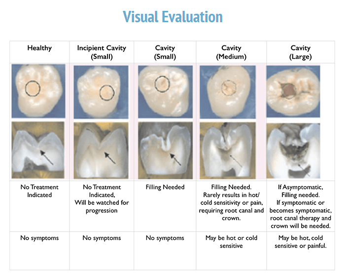 Why It's Important to Fix a Cavity When It Is Small