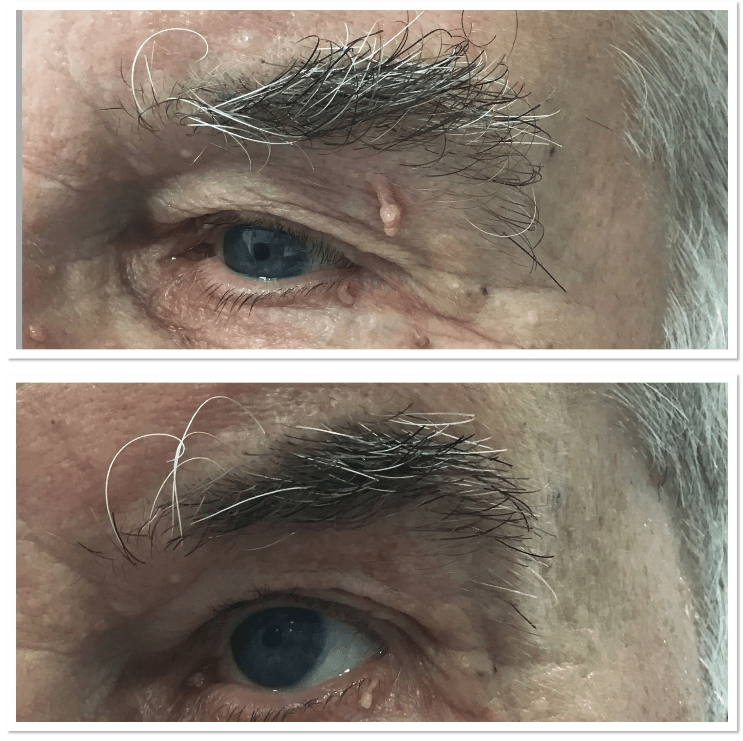 Skin Tag Removal Epilation Services Wetherby Revekka Treatments