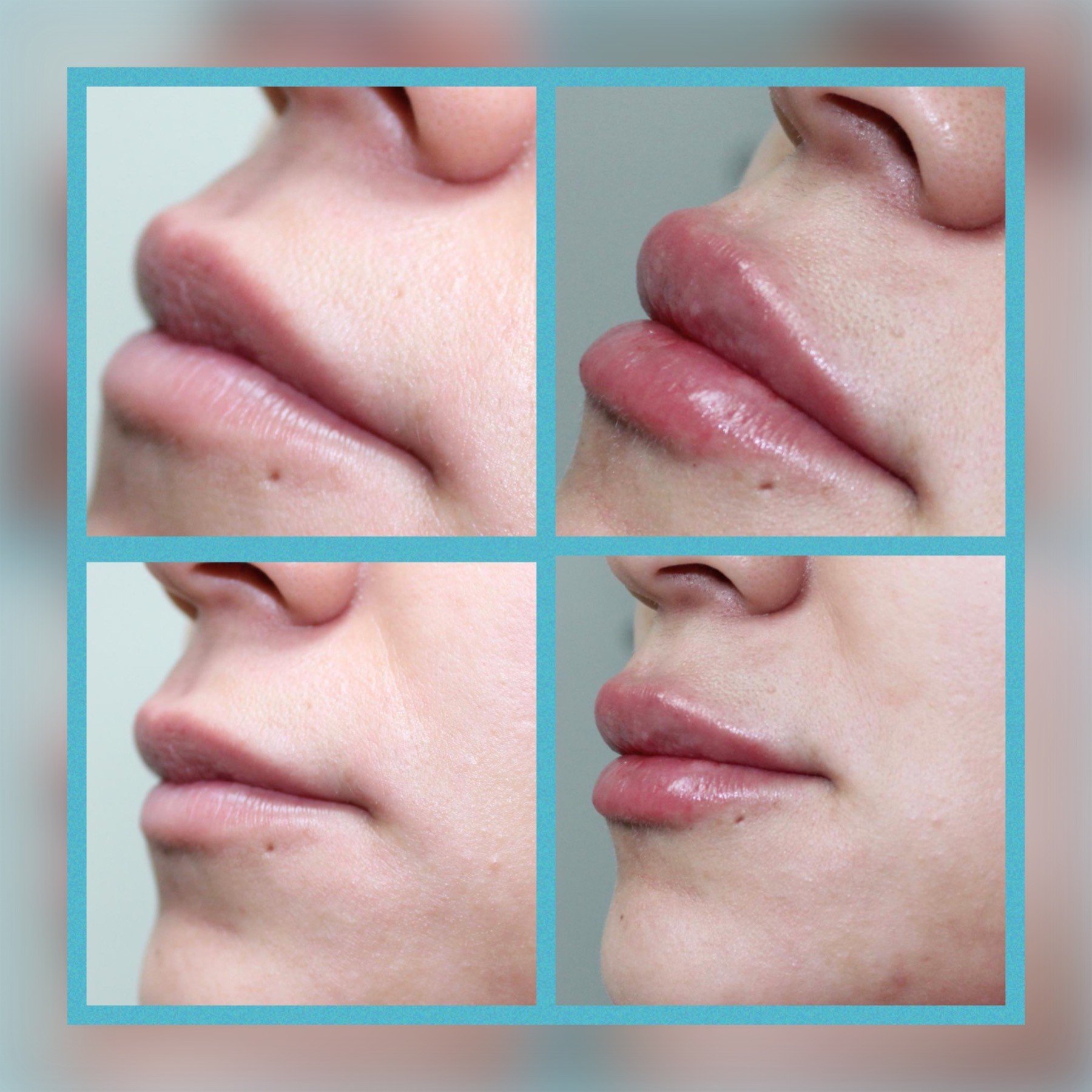 Botox® and Dermal Fillers Houston, TX Clinic 45