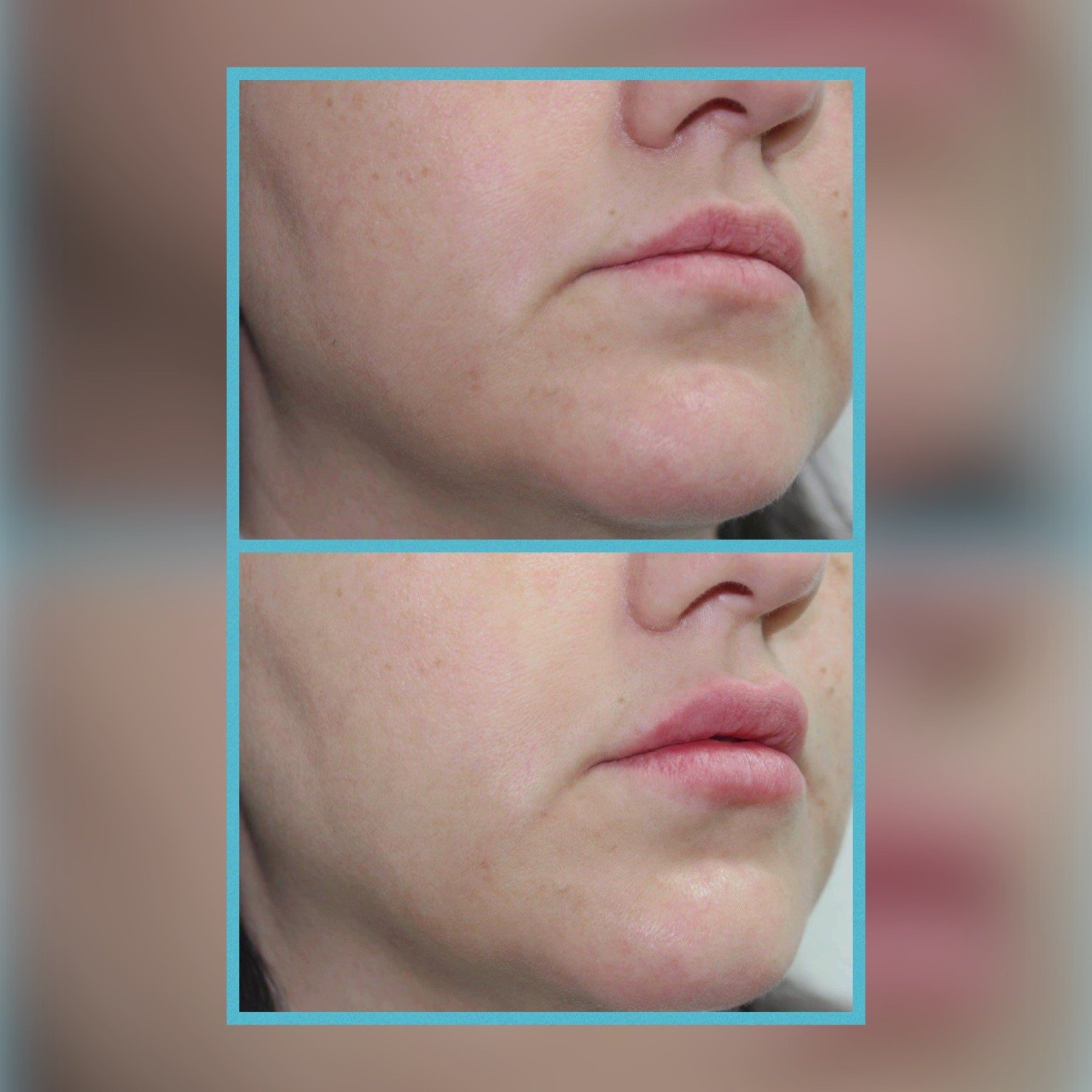 Botox® and Dermal Fillers Houston, TX Clinic 45