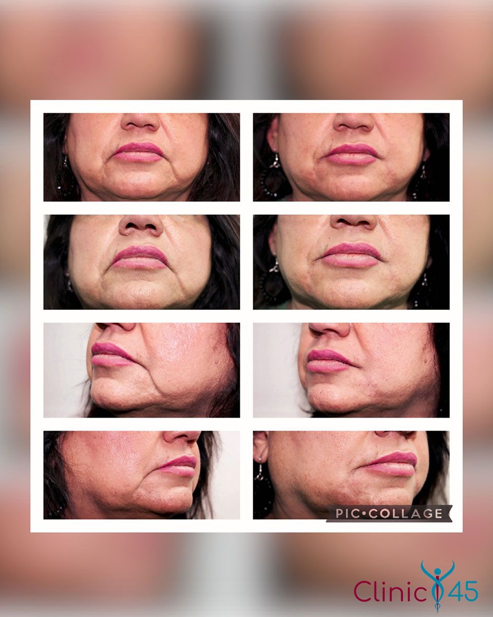 Botox® and Dermal Fillers Houston, TX Clinic 45