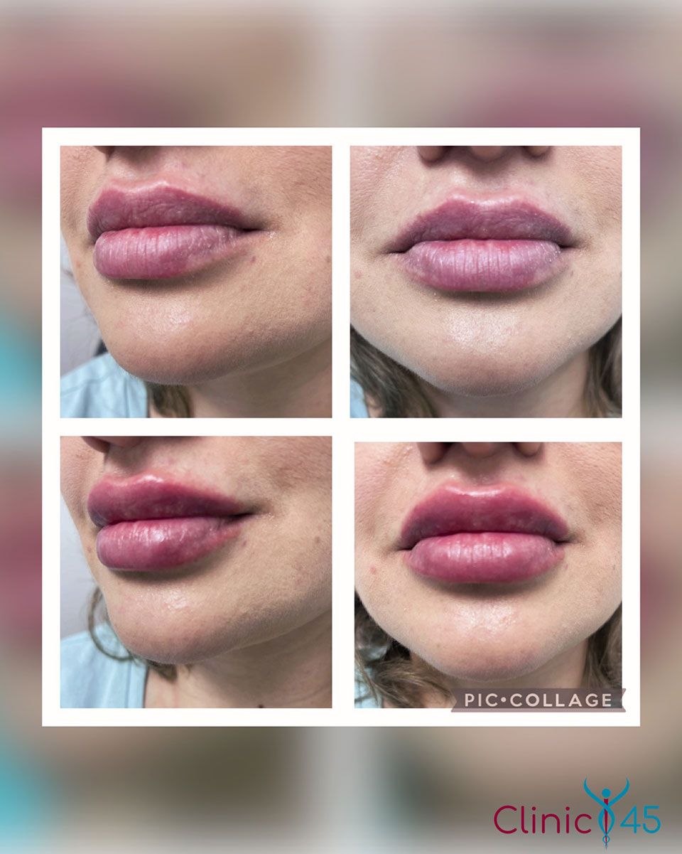 Botox® and Dermal Fillers Houston, TX Clinic 45