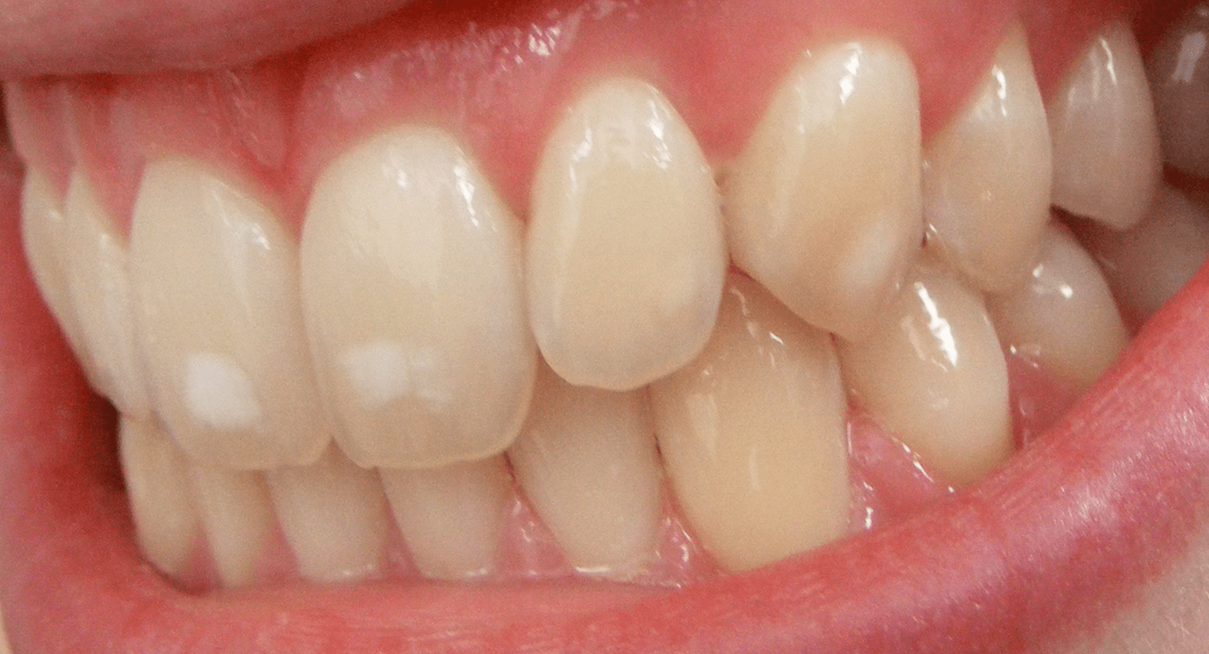 Fluorosis