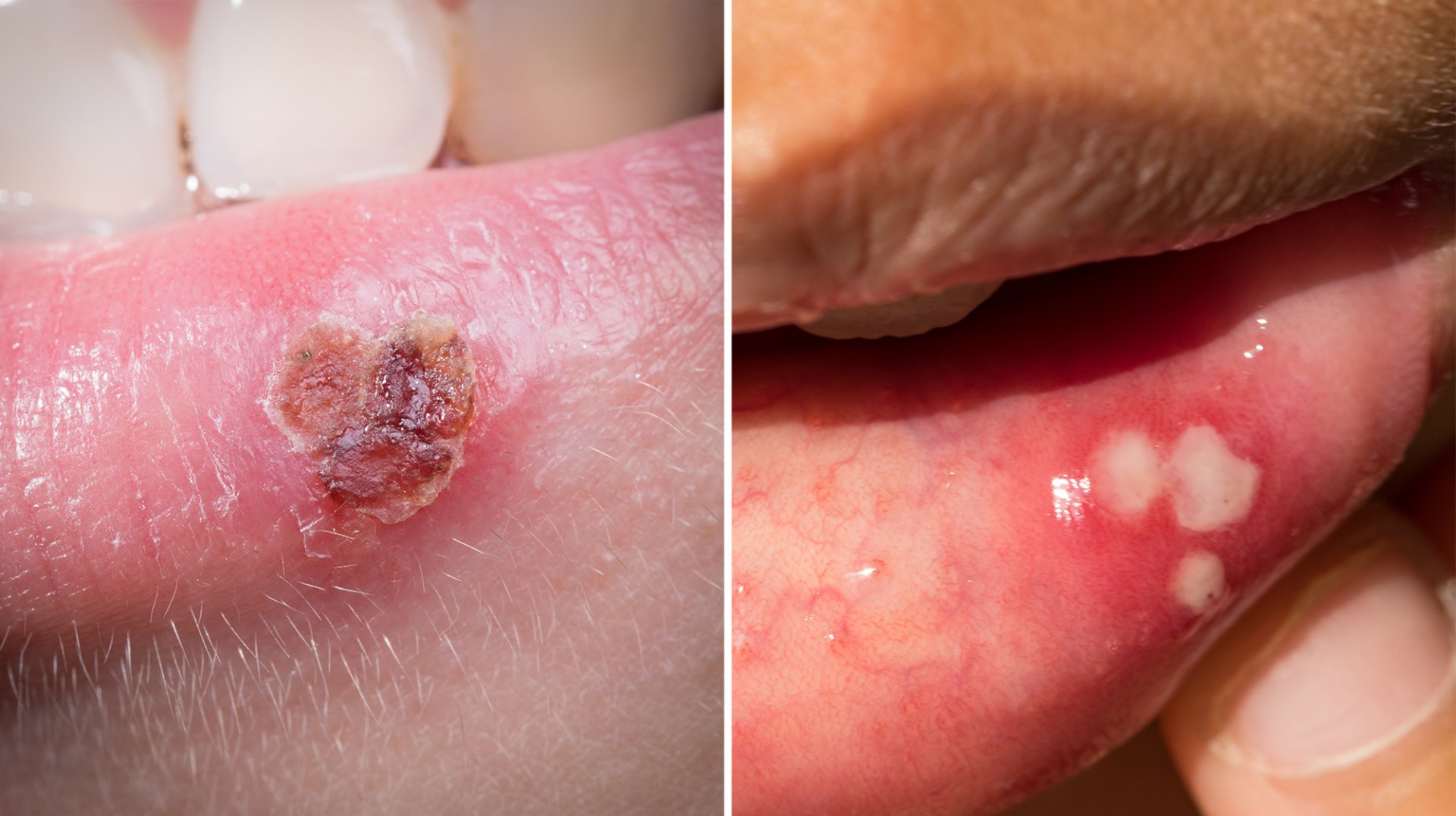 CANKER/COLD SORES