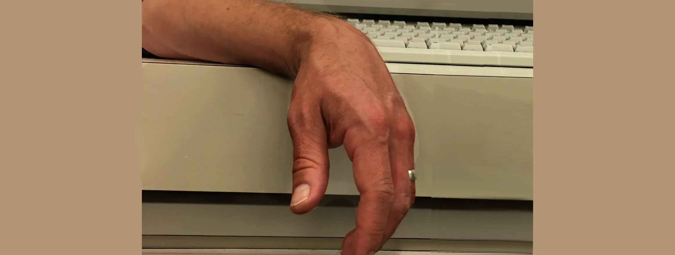 11 Causes of Hand Weakness