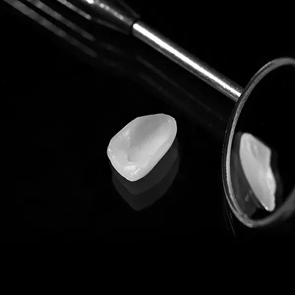 Dantų laminatės Klaipėdoje Klaipedosoc.lt