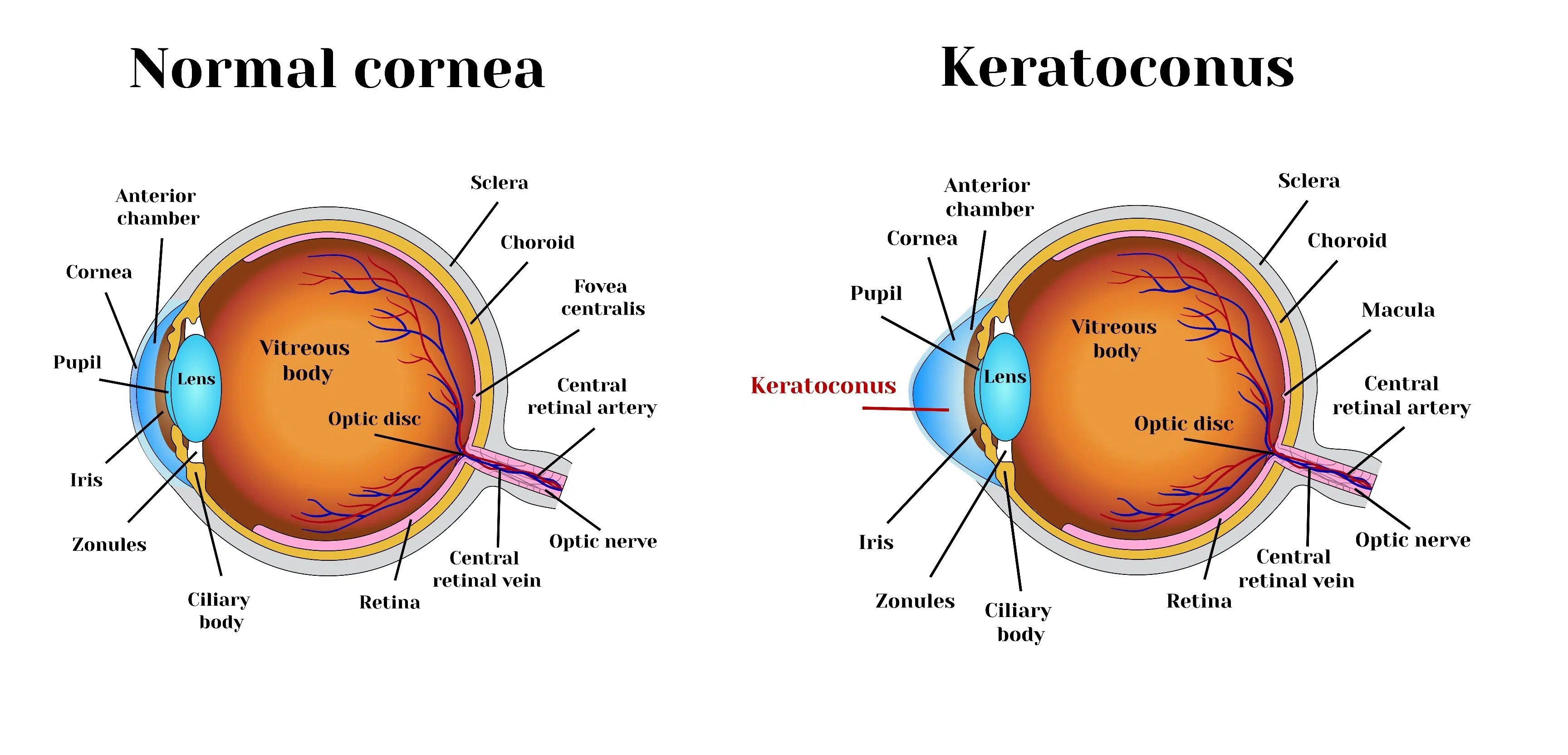 Keratoconus Southside Eye Centre