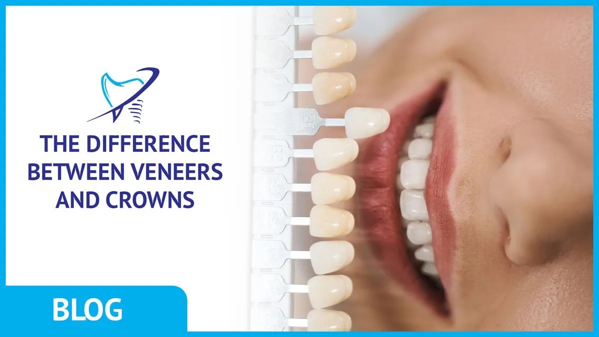 The Difference Between Veneers and Crowns Westlake Dental Care