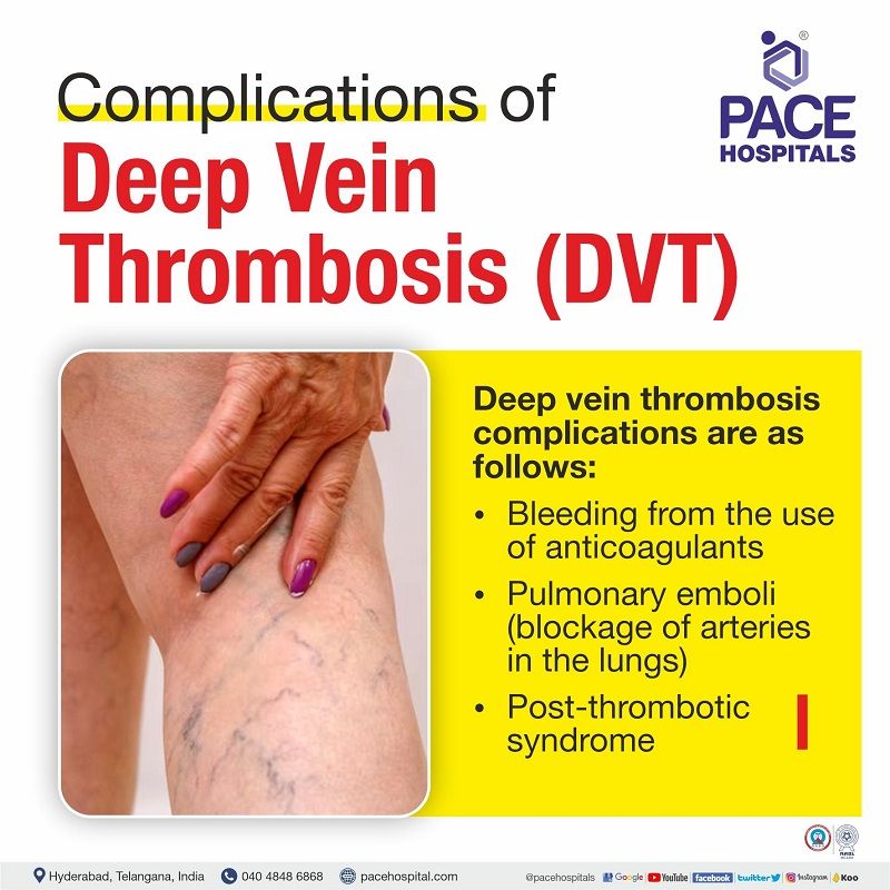 Deep Vein Thrombosis, DVT Symptoms, Causes and Complications