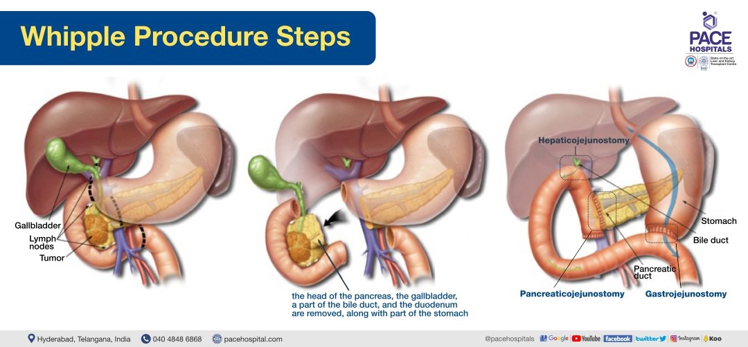 Best Hospital for Whipple Procedure in Hyderabad Surgery and Cost
