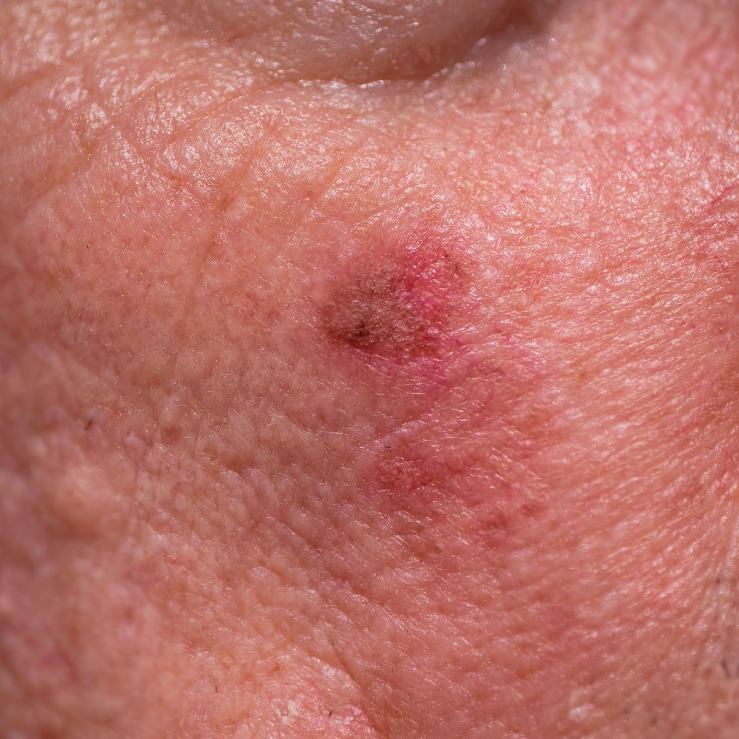 Skin Cancer Skin Cancer Ballarat