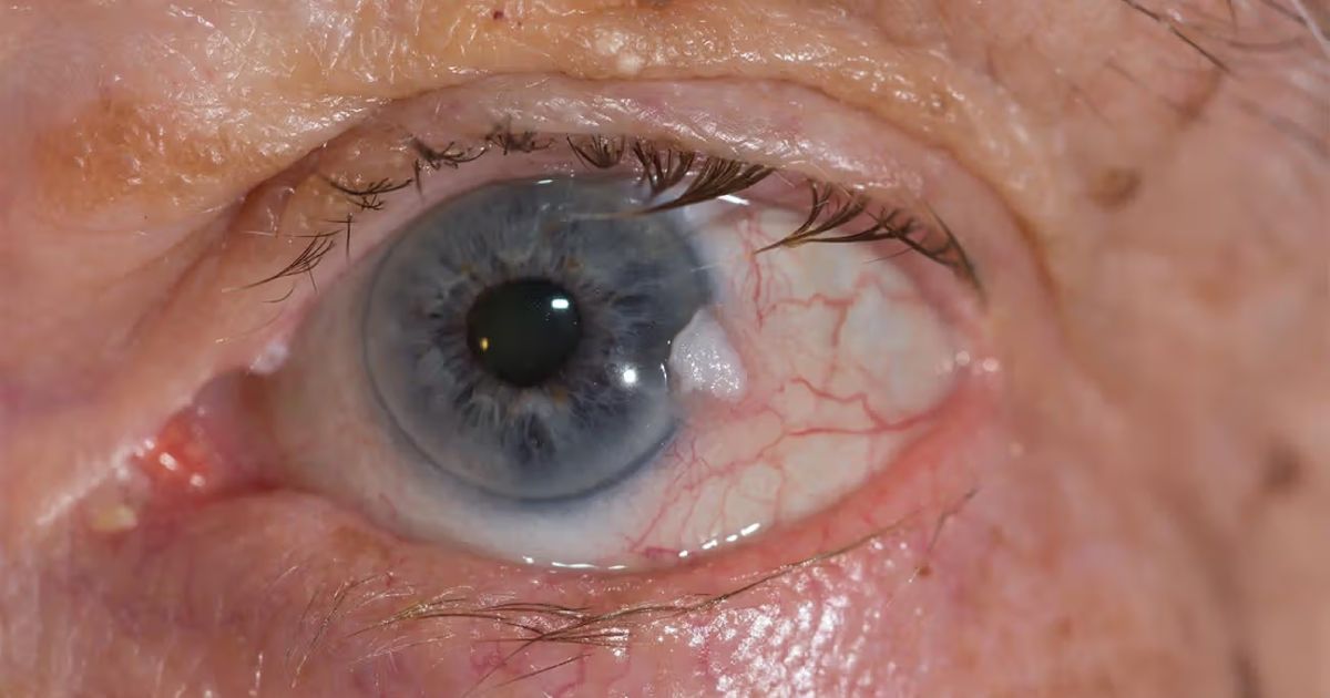 Exploring EyeRelated Cancers Types, Symptoms, and Treatments
